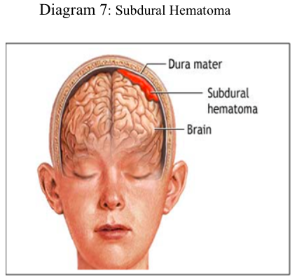 brain injury pt 2 diagram7