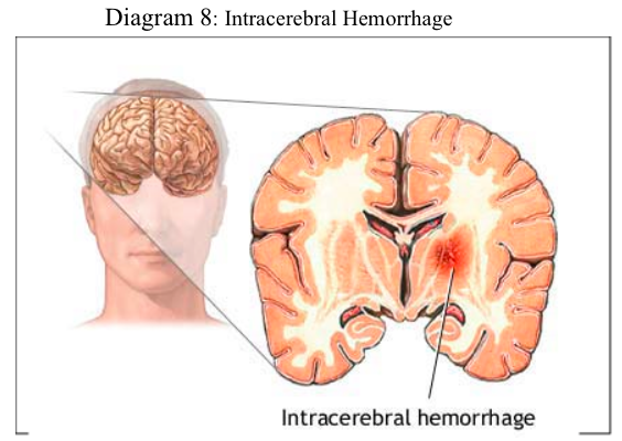 brain injury pt 2 diagram8