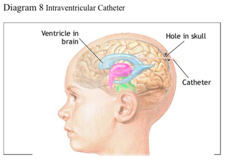 brain injury series pt 3 catheter